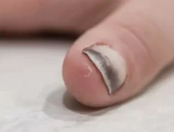 Misteri Kuku yang Bisa Meramalkan Kanker, Benarkah?